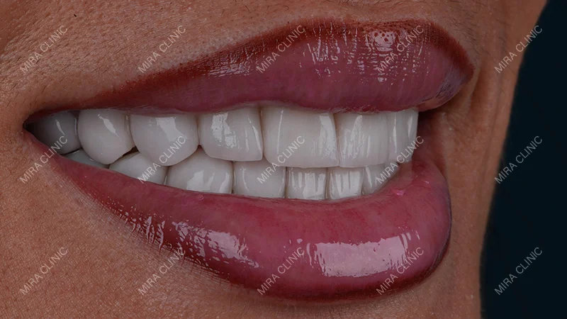 E-max Restorations Helped Improve Her Smile